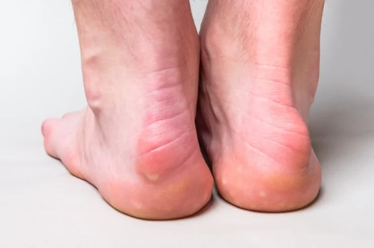 Deformities