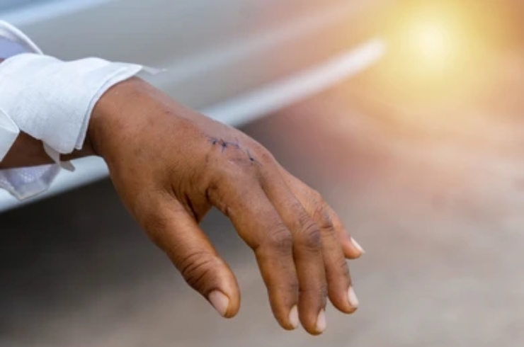 Hand injury
