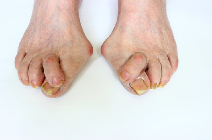 Post Deformities-
